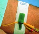 Dale Foley Catheter Holder - Easy to put on and take off, the Dale&#174; Foley Catheter Holder fea